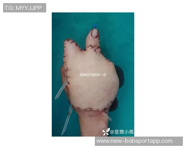 安东尼戴维斯左手伤势无须手术预计六周内完全恢复